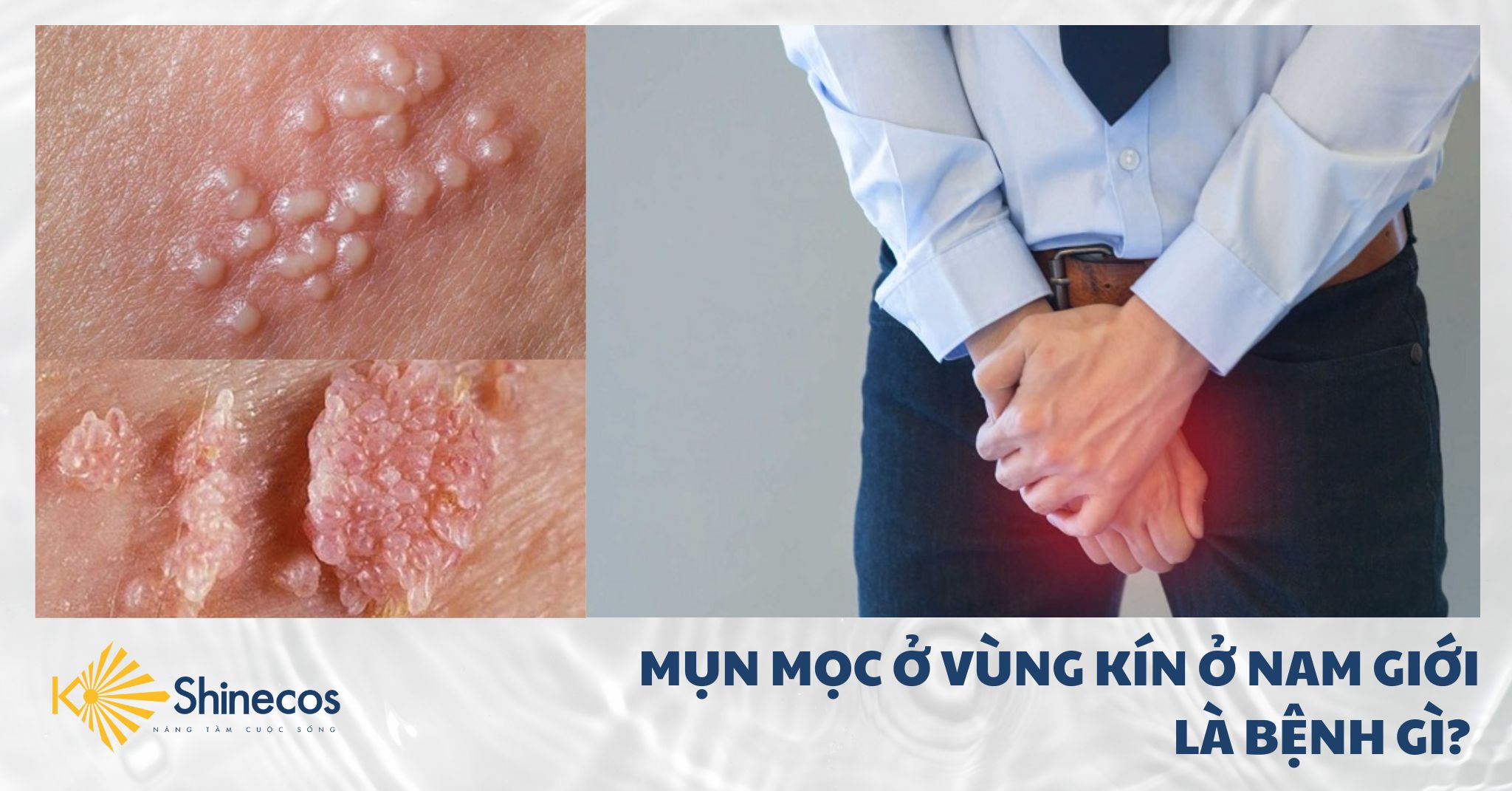 MỤN MỌC Ở VÙNG KÍN Ở NAM GIỚI LÀ BỆNH GÌ?