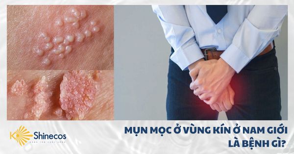 MỤN MỌC Ở VÙNG KÍN Ở NAM GIỚI LÀ BỆNH GÌ?