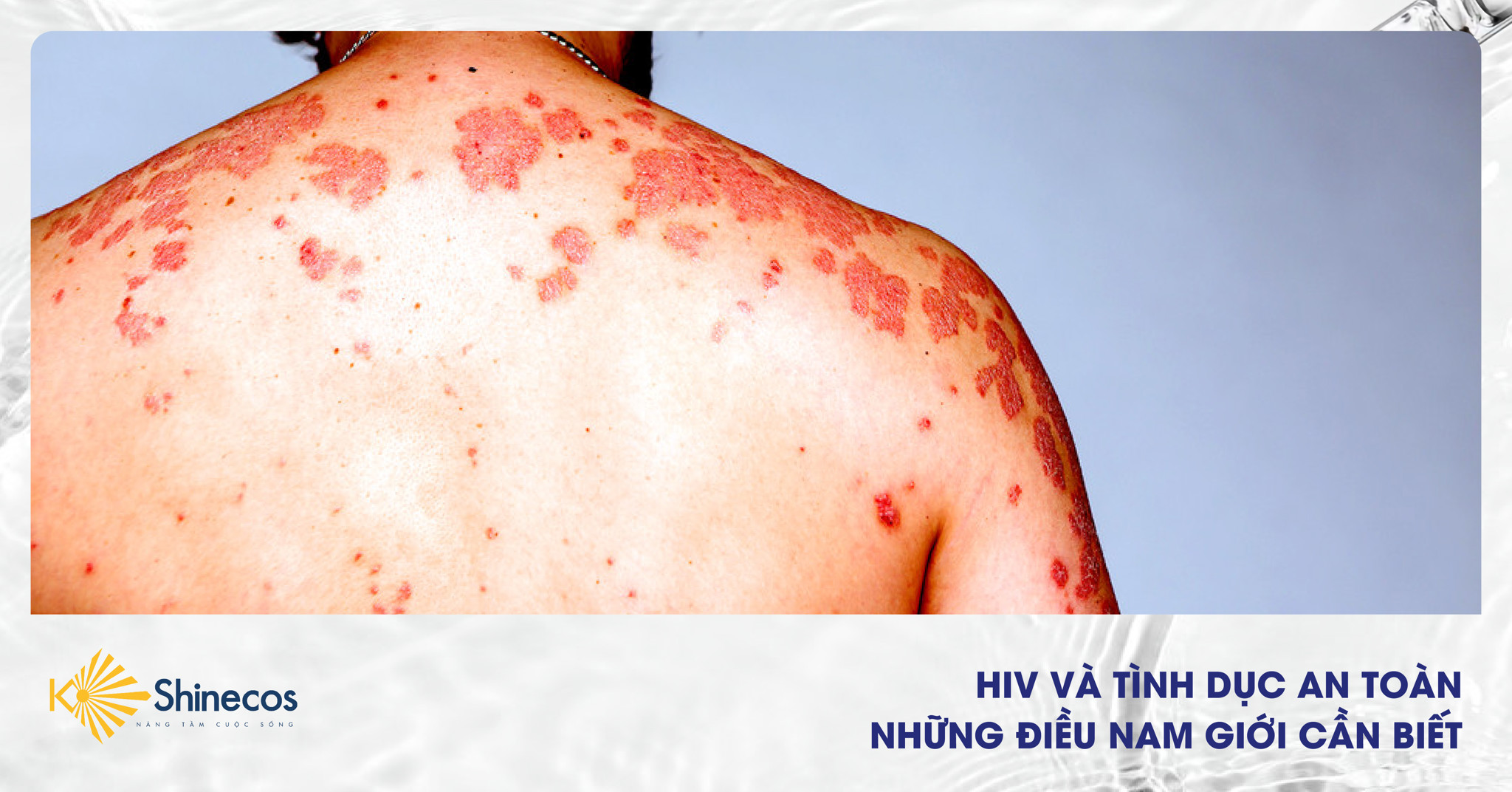 HIV VÀ TÌNH DỤC AN TOÀN – NHỮNG ĐIỀU NAM GIỚi CẦN BIẾT