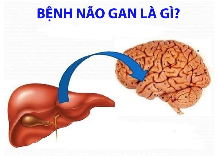 Bệnh não gan là gì? Nguyên nhân, triệu chứng