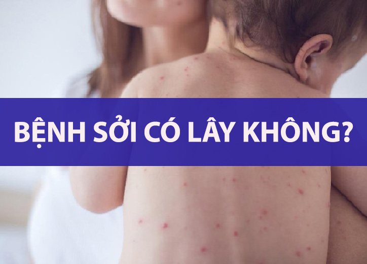 Bệnh sởi có lây không? Giải đáp chi tiết và cách phòng tránh