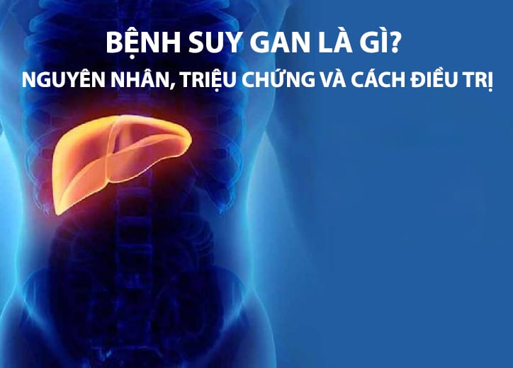 Bệnh suy gan là gì? Nguyên nhân, triệu chứng và cách điều trị