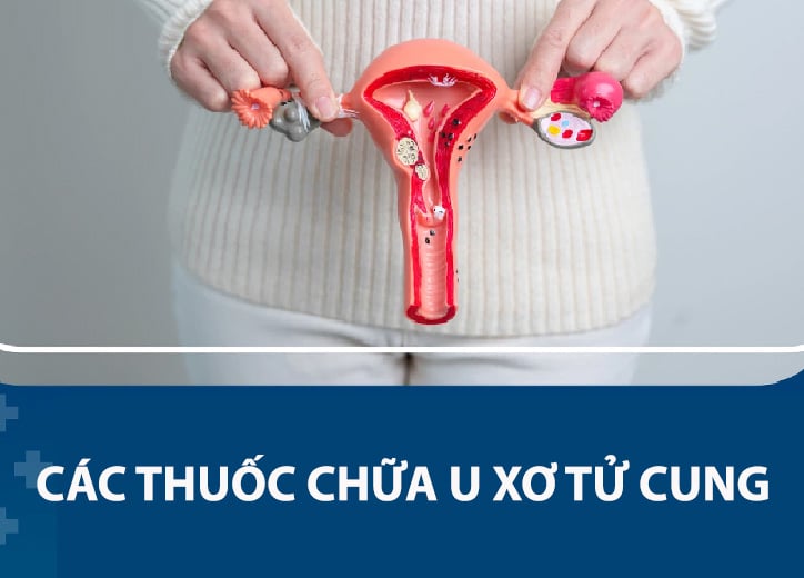 Các thuốc chữa u xơ tử cung tốt nhất hiện nay