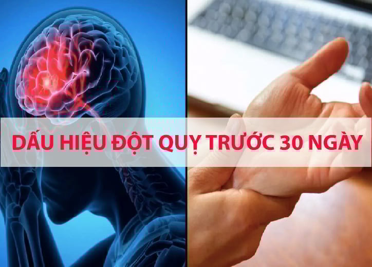 Dấu hiệu đột quỵ trước 30 ngày: Nhận biết và phòng ngừa