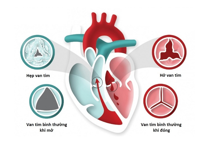 Dấu hiệu hở van tim và nguyên nhân gây ra là gì?