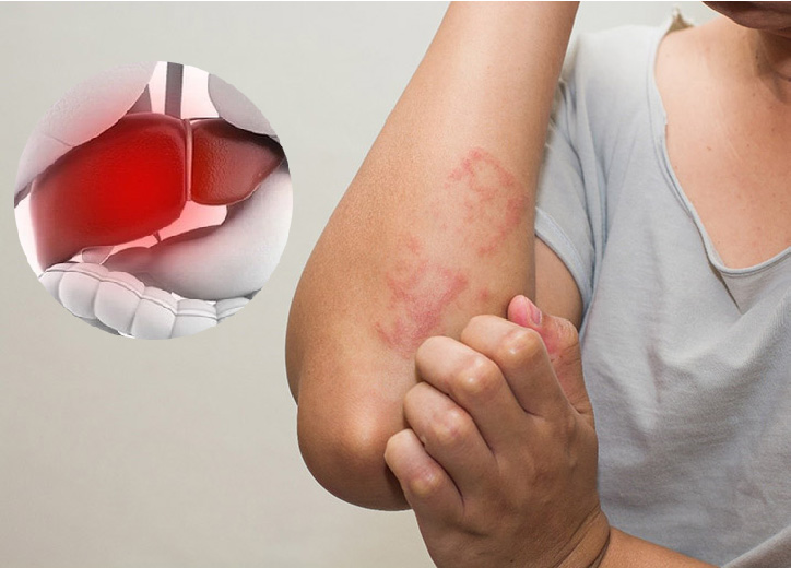 Sẩn ngứa do gan: Tìm hiểu về triệu chứng, nguyên nhân và cách phòng ngừa