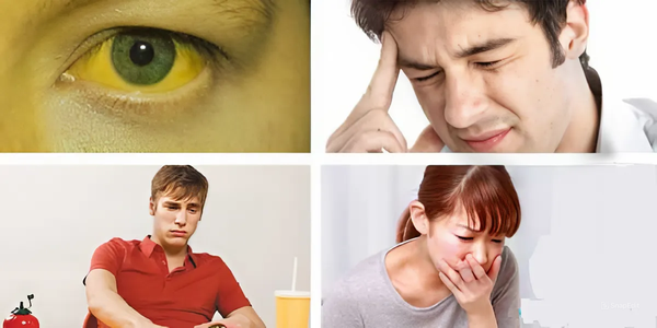 vàng da vàng mắt chán ăn do gan yếu