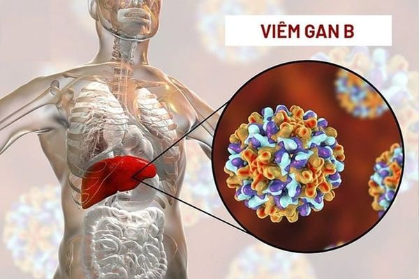 Viêm gan B mạn tính