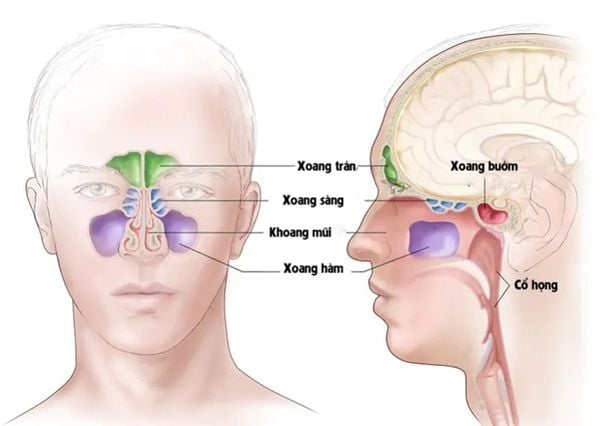 Viêm xoang sàng sau