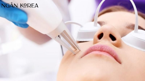 bắn laser trị nám