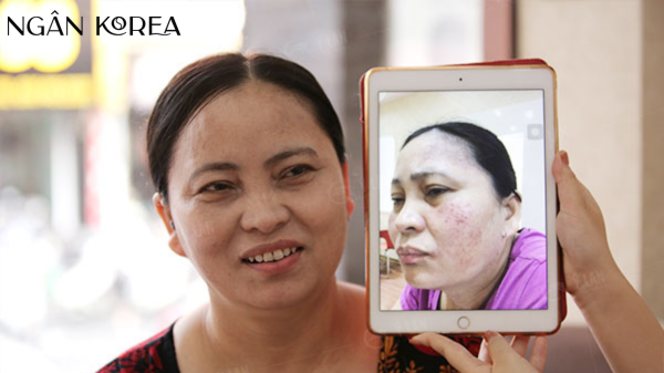 Nám tuổi 50