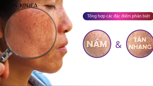 Nám và tàn nhang khác nhau ở đâu?