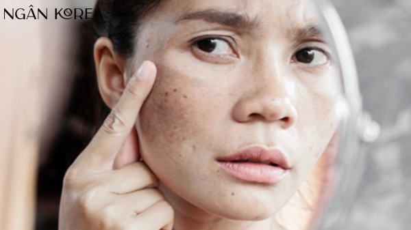 Kem trị nám cho tuổi 40