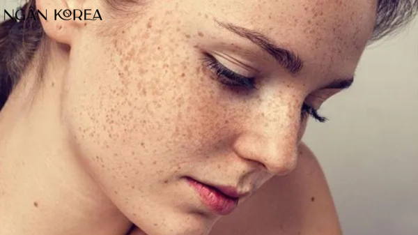 cách trị nám từ bên trong