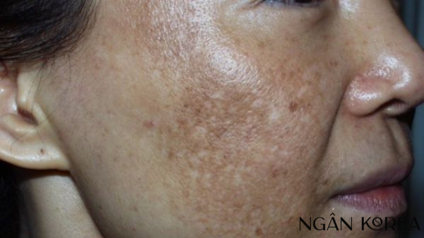 nám nội tiết