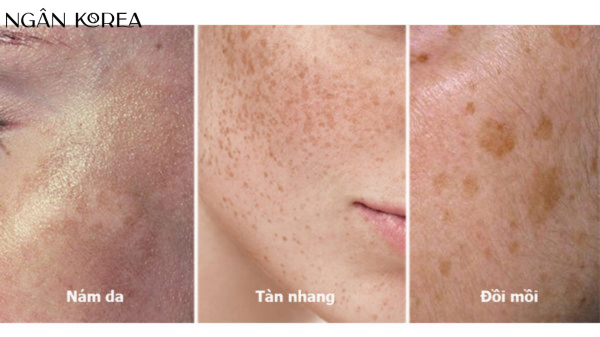 Nám đốm là gì?
