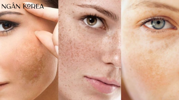 Nám hỗn hợp là gì?