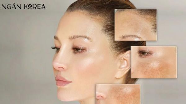 cách trị nám từ bên trong