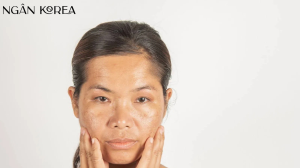 Kem trị nám cho tuổi 40