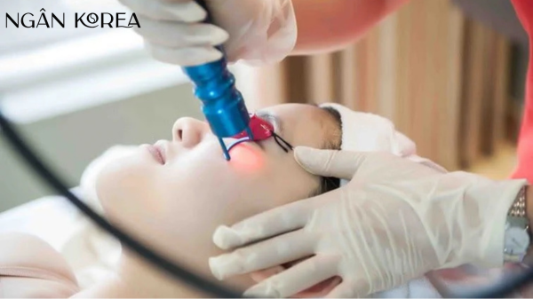 bắn laser trị nám