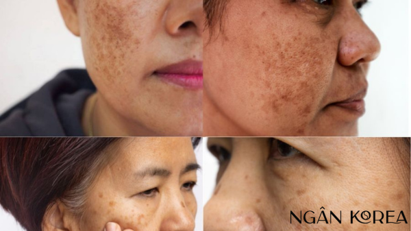 nám nội tiết