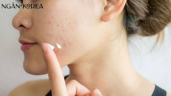 Da bị nám nên uống vitamin gì