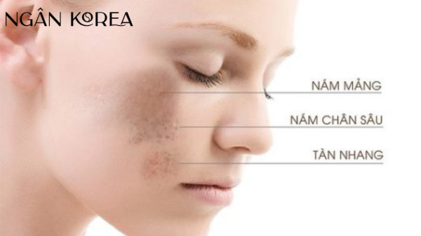 Dùng kem chống nắng có bị nám da không?