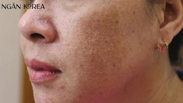 Nám hỗn hợp là gì?
