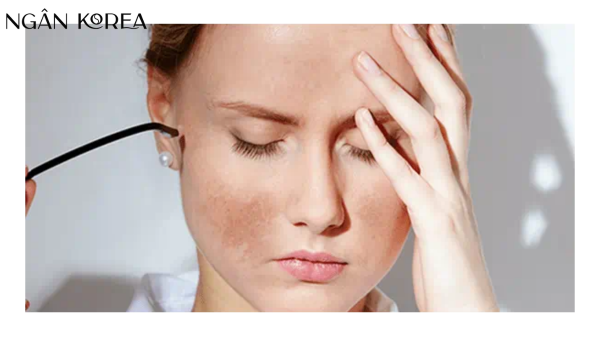 Nám hỗn hợp là gì?