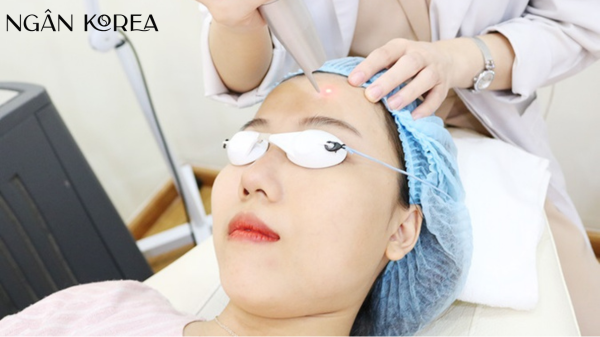 bắn laser trị nám