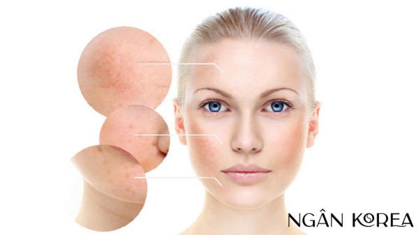 tranexamic acid kết hợp với azelaic acid