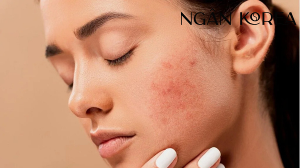 tranexamic acid dùng chung với retinol