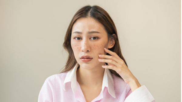 Nám tàn nhang