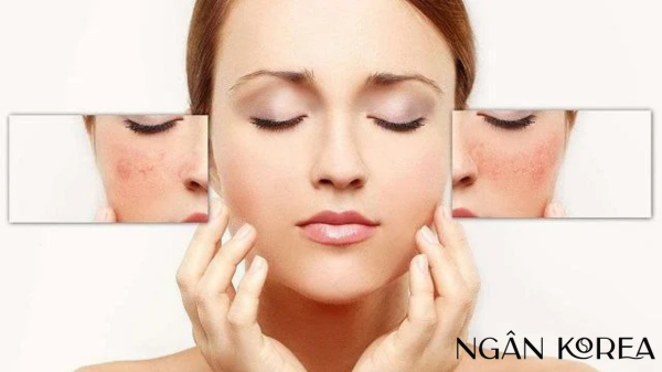 tranexamic acid kết hợp với azelaic acid