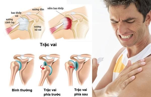 Điều trị viêm khớp quanh khớp vai và các bài tập phục hồi chức năng