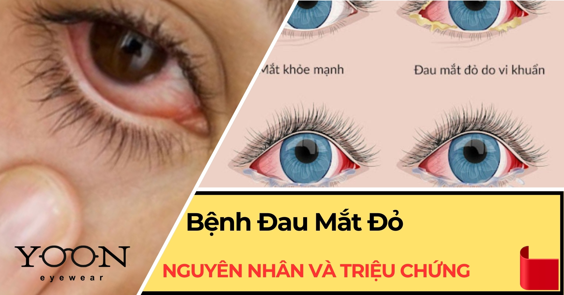 Bệnh Đau Mắt Đỏ - Nguyên Nhân Và Triệu Chứng