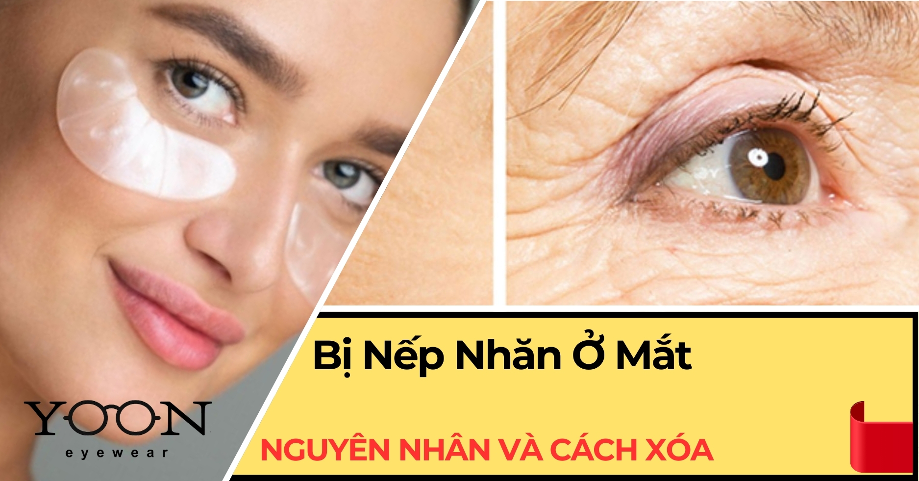 Bị Nếp Nhăn Ở Mắt - Nguyên Nhân Và 5 Cách Xóa Tại Nhà Hiệu Quả