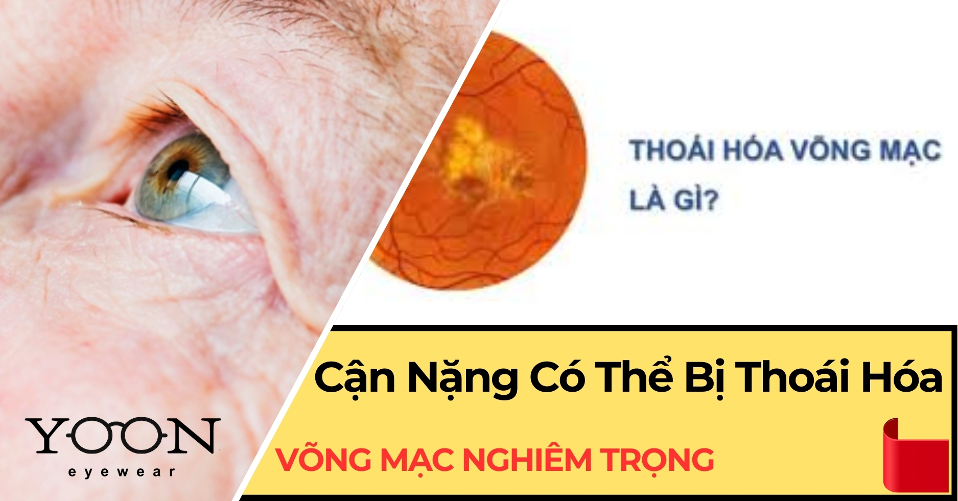 Cận Nặng Có Thể Bị Thoái Hóa Võng Mạc Nghiêm Trọng?