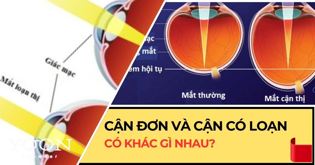 Cận Thị Đơn Và Cận Có Loạn - Có Gì Khác Nhau?