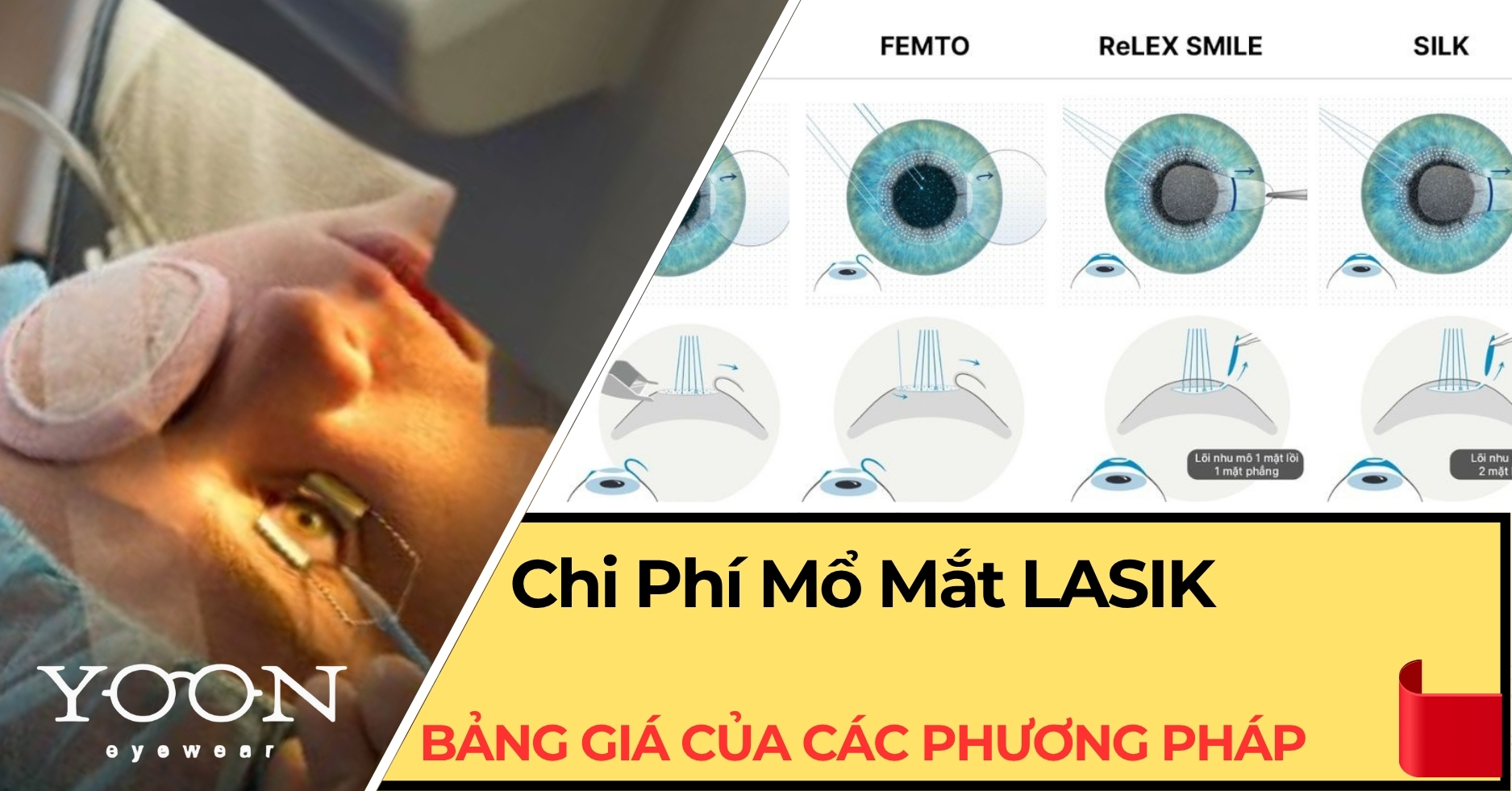 Chi Phí Mổ Mắt LASIK Mới Nhất 2025: Bảng Giá Các Phương Pháp Phổ Biến