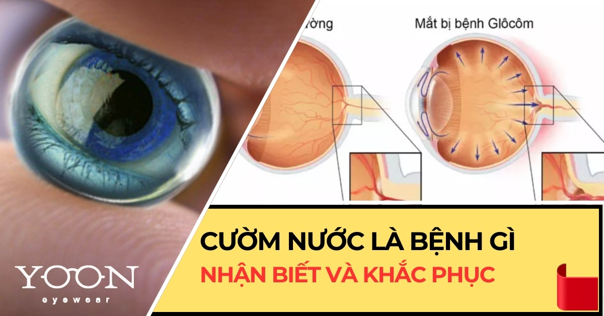 Cườm Nước (Glaucoma) Là Bệnh Gì? Nhận Biết Và Khắc Phục