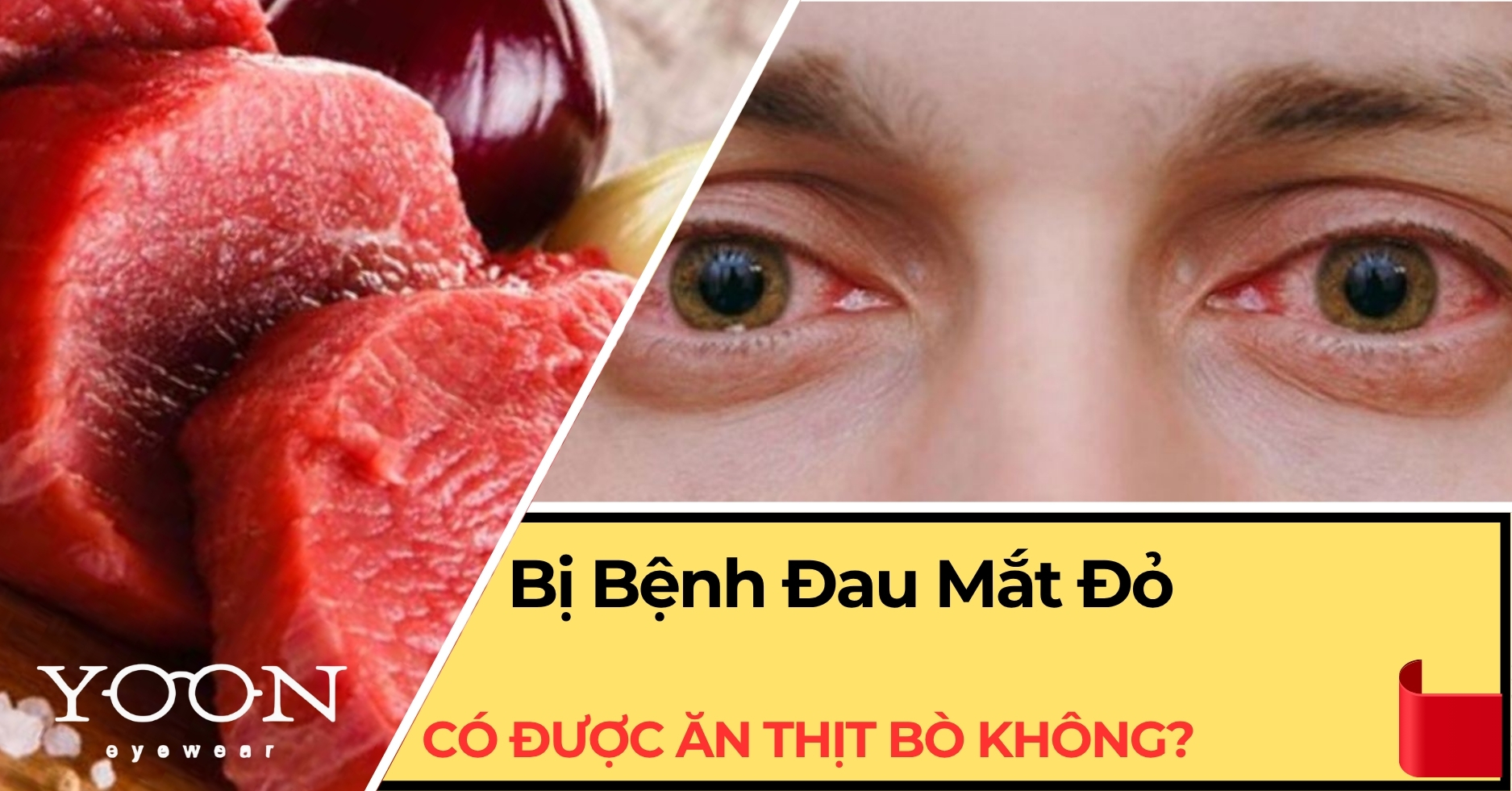 Đau Mắt Đỏ Có Được Ăn Thịt Bò Không?