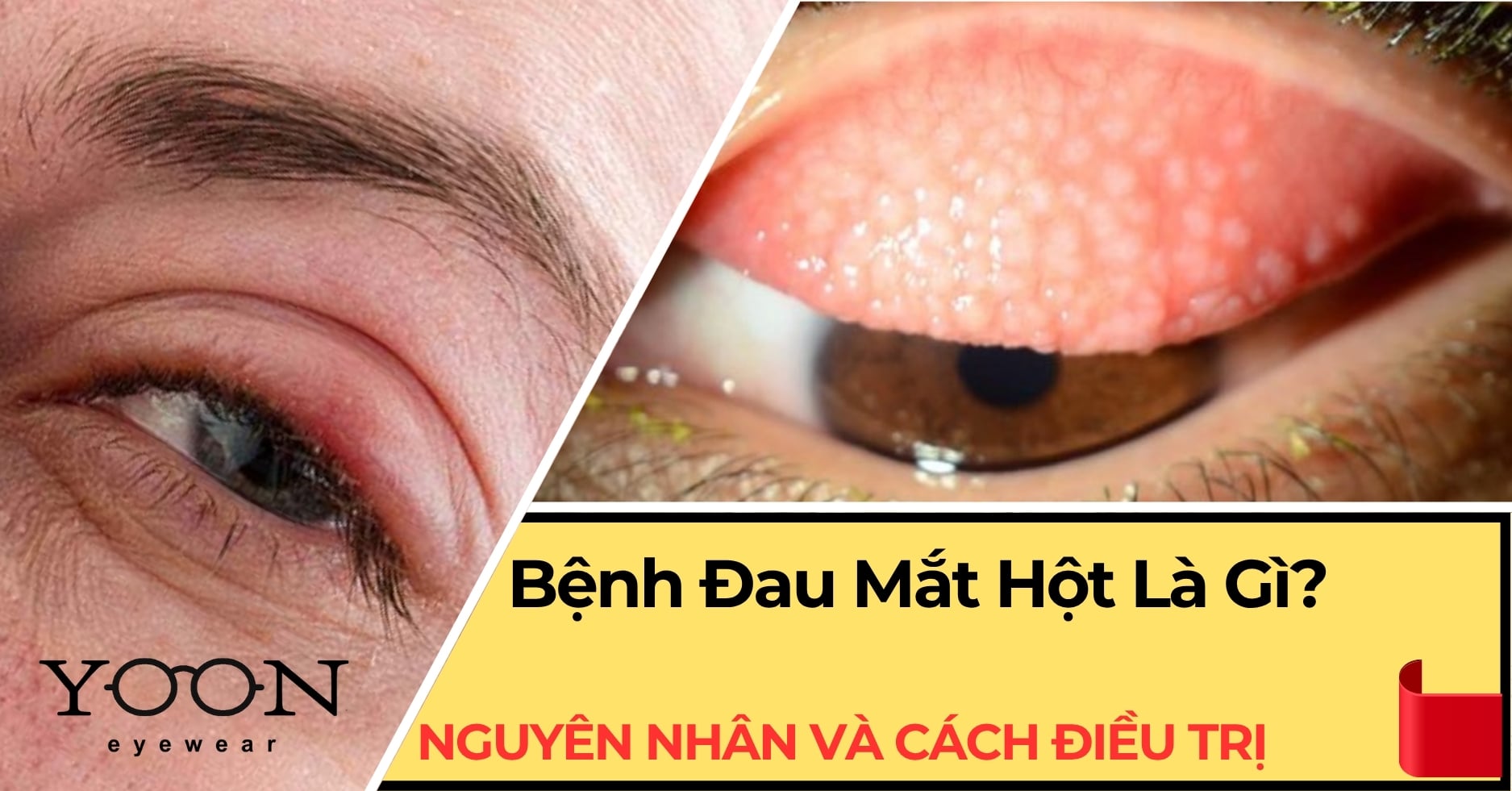Đau Mắt Hột Là Gì? Nguyên Nhân, Triệu Chứng Và Cách Điều Trị Hiệu Quả