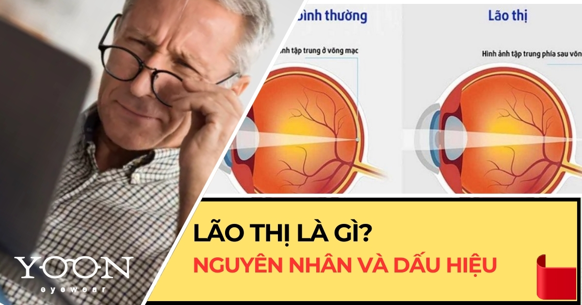 Lão Thị Là Gì? Nguyên Nhân Và Dấu Hiệu