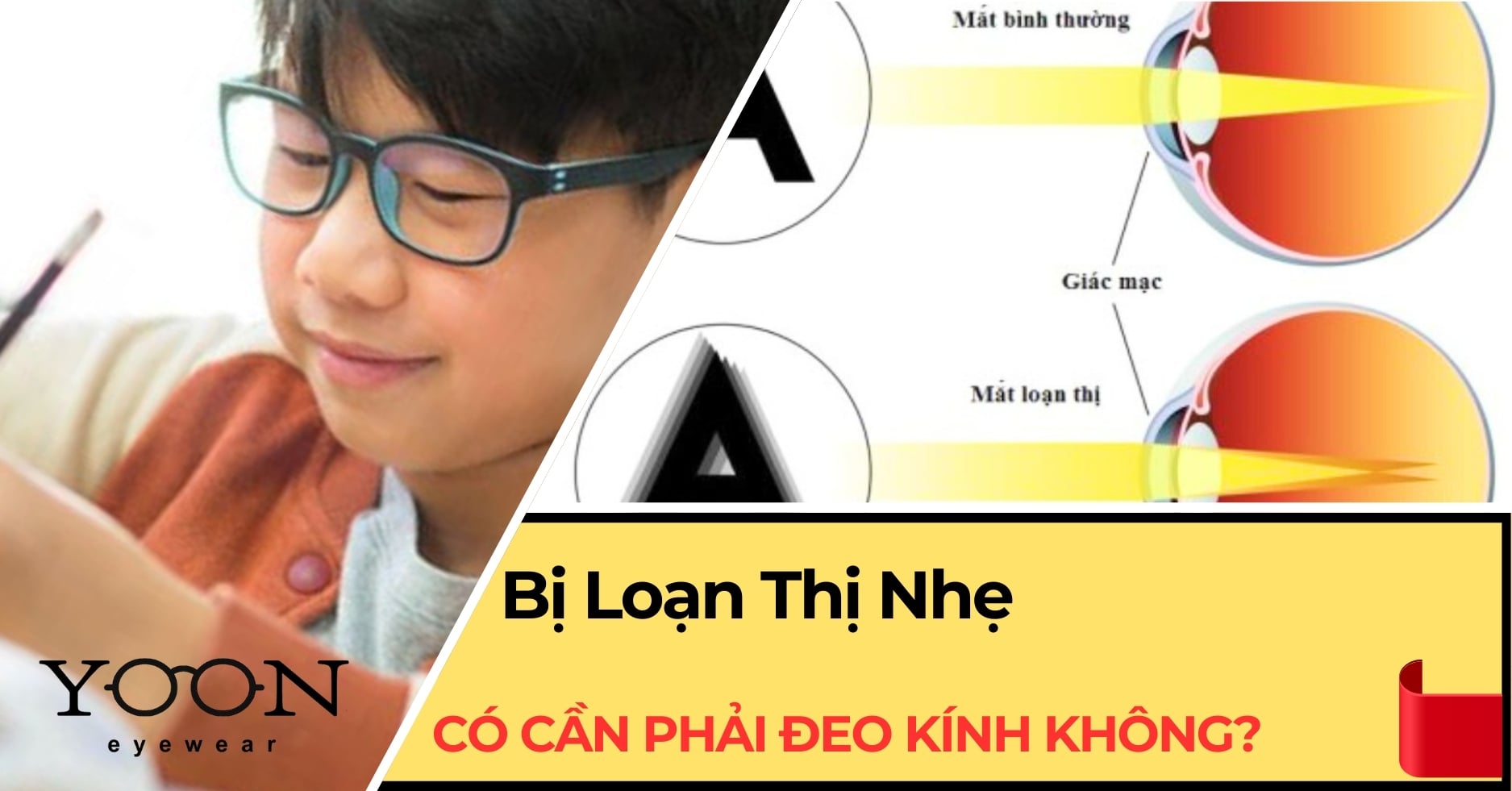 Loạn Thị Nhẹ Có Cần Phải Đeo Kính Không? Mấy Độ Thì Nên Đeo?