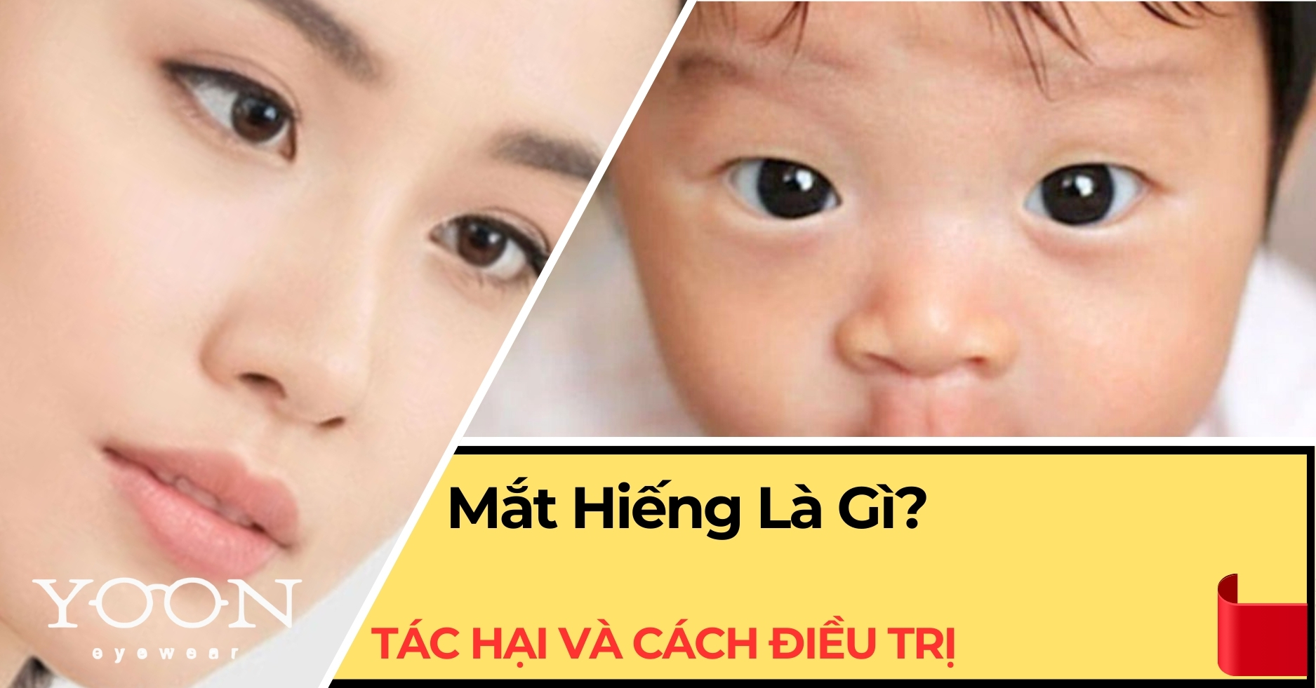 Mắt Hiếng Là Gì? Tác Hại Và Cách Điều Trị Mắt Hiếng Ở Trẻ Em