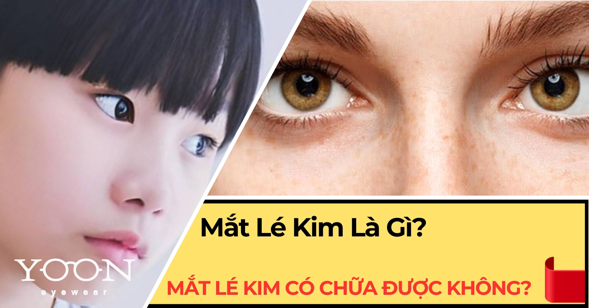 Mắt Lé Kim Là Gì? Mắt Lé Kim Có Chữa Được Không?
