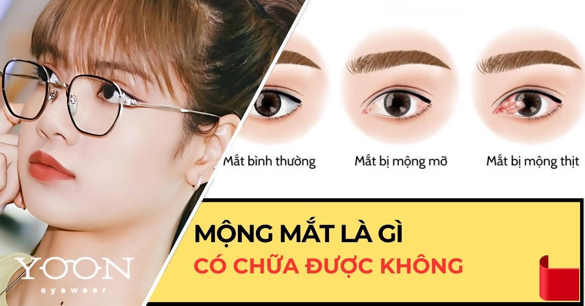 Mộng Mắt Là Gì? Bị Mộng Mắt Có Chữa Được Không?