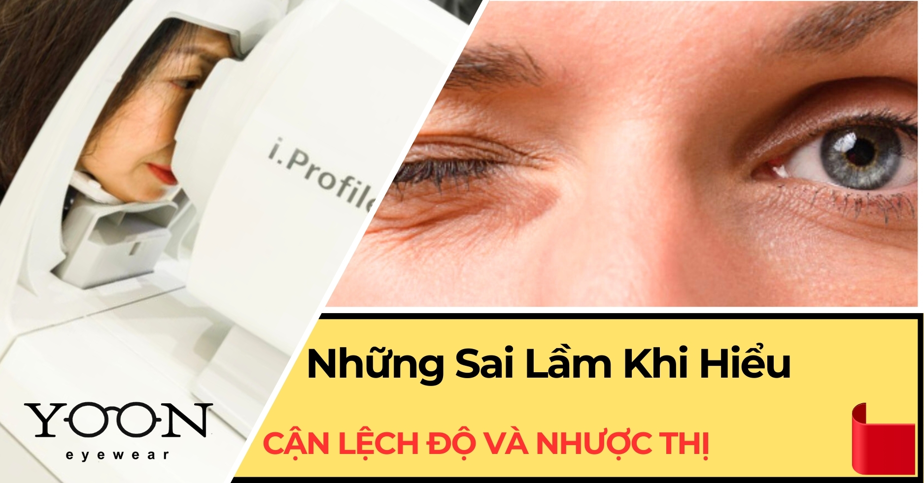 Những Sai Lầm Khi Hiểu Cận Lệch Độ Với Nhược Thị Là Một