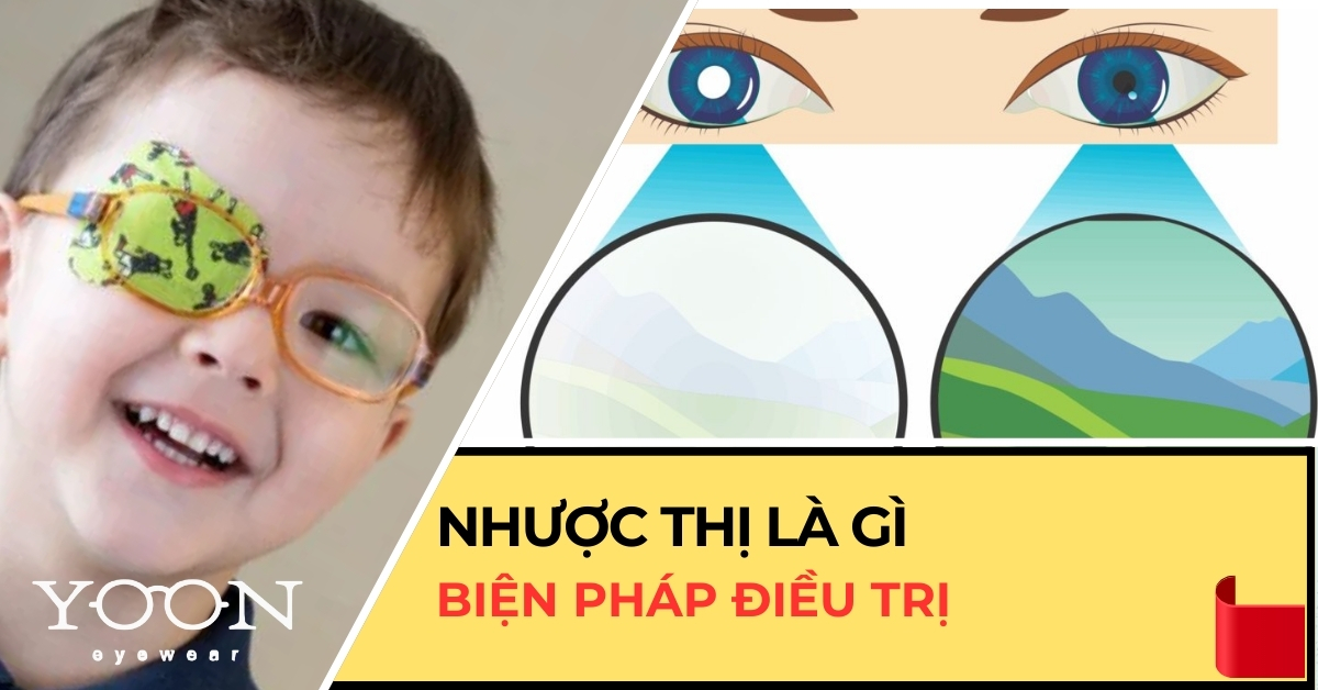 Nhược Thị Là Gì? Lý Do Bị Nhược Thị